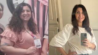 1 year post op #sadi #weightlossjourney #weightlosssurgery #weightlossmotivation #postop