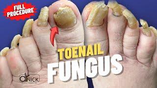 Cutting Extremely Thick Fungal Toenails | Dr. Nick Campitelli