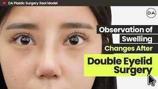 [Plastic Surgery Korea] Observation of Swelling Changes After Double Eyelid Surgery