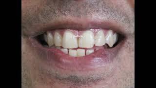 Smile makeover for Bad fillings and Discoloration by  Dr Trivikram Rao
