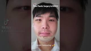 [Plastic Surgery Korea] Male plastic surgery‍️ #male  #plasticsurgerykorea #viewplasticsurgery