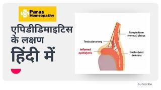 Epididymitis Symptoms, Causes and Treatment | Epididymitis Homeopathy Medicine | Paras Homeopathy