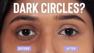 Home remedies to remove dark circles QUICKLY and NATURALLY!