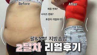 팔&복부 지방흡입 2달 차 리얼후기 | 붓기, 뭉침, 체중&사이즈 변화, 후관리 궁금한 거 다 답해드림!