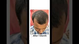 Successful Treatment Of Hairfall By Hijama Cupping Therapy