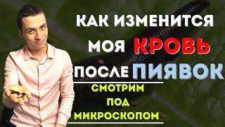 Как ставить пиявки в домашних условиях!? Польза «Гирудотерапии»