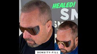 Scalp Density-Fill - Micropigmentation - SMP - Kentucky