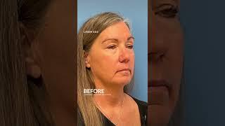 CO Laser Skin Resurfacing Before and After #co2lasertreatment #skinresurfacing #antiageingskincare