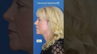 NECK TRANSFORMATION! Facelift for a Tighter Sculpted Neck!