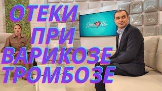Как распознать венозные отеки. Флеболог Абасов на ТВЦ.