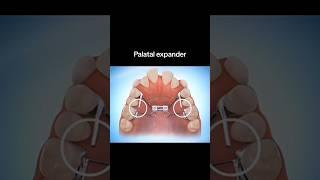 Treatment of Crowding Teeth..#crowding #shorts #trending #youtube
