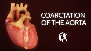 Coarctation of the Aorta