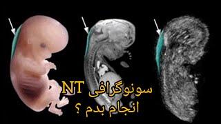 سونوگرافی NT.nB.سونوگرافی آنومالی اسکن.چطپر انجام .لازم هستش سونو انجام بدم