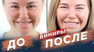 ВИНИРЫ ДО И ПОСЛЕ. Потрясающая голливудская улыбка