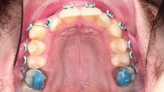 The Art of Braces- Smile Transformation