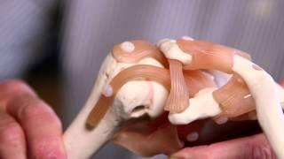 Treating Stiff Joints