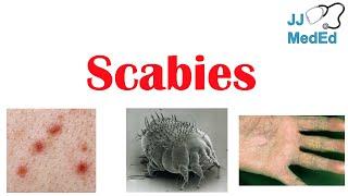 Scabies (Skin Condition) | What Is It, Classic vs. Crusted Types, Signs & Symptoms, Treatment