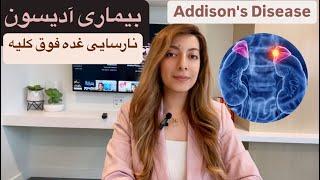 بیماری آدیسون/ نارسایی غدد فوق کلیوی/Addison's disease