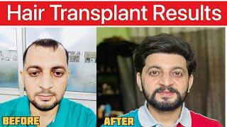 Documenting My Hair Transplant Journey | My 2.5 Years Hair Transplant Results Progression | Cost |