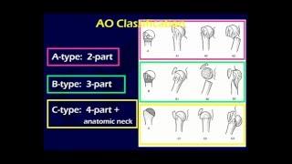 Proximal Humerus Fractures 1 (OTA lecture series III u03a)