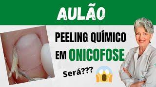 Aulão Peeling Químico em Onicofose Será que Funciona