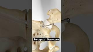 Securing a shallow hip socket (3D Animation)