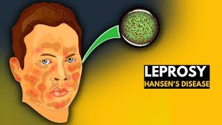 Leprosy (Hansen's disease): Everything You Need to Know