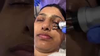 Best Hydrafacial in Zirakpur