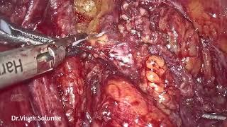 EXCISION OF RESIDUAL ENDOMETRIOSIS WITH BOWEL SHAVING