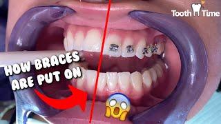 How Braces are put on - Dental Braces Tooth Time Family Dentistry New Braunfels Texas