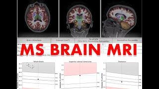 Understand your Brain Scan: MS MRI