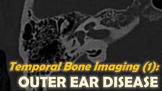 Temporal bone Imaging (1): Outer Ear Disease