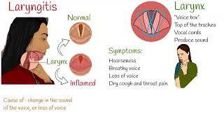 Laryngitis -  Symptoms, causes and treatment