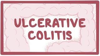 Ulcerative colitis - causes, symptoms, diagnosis, treatment, pathology