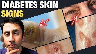 Doctor Explains 13 Skin Signs of Diabetes - Never Ignore These Symptoms (High Sugar)