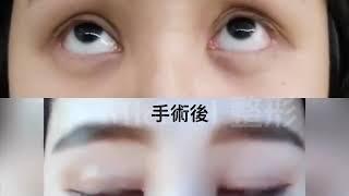 雙眼皮修復/三眼皮