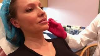 Silhouette InstaLift Non-Surgical Face Lift | Total Dermatology