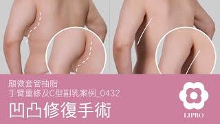 凹凸修復手術｜顯微套管抽脂｜手臂重修及C型副乳案例_0432