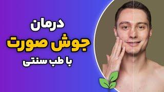 درمان جوش صورت با طب سنتی || با معجزه داروی مصفای خون آشنا بشید!