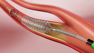 Carotid Angioplasty and Stenting (3D Animation)