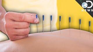 Does Acupuncture Even Work?