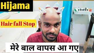 Cupping Therapy for hair fall! Hijama for hair regrowth