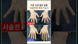 마른 손등,혈관 돌출 10분만에 해결 가능? | 손등필러 지방이식 볼륨 #modsclinic #모즈의원 #손등필러