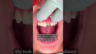 2 front teeth | porcelain crowns | dental crowns before and after | Dr. Yazdan | smile makeover