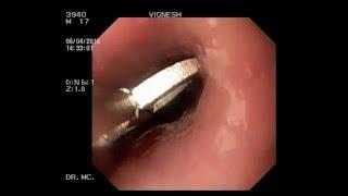 ENDOSCOPIC REMOVAL OF METAL RING FROM MID OESOPHAGUS