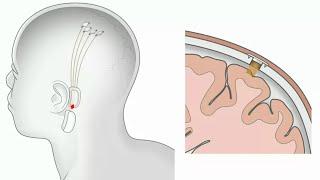 Neuralink Tanıtım Videosu