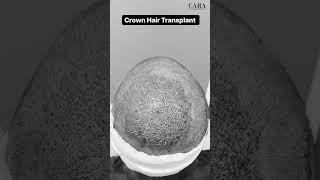 FUE Crown Hair transplant in Mumbai | 1970 hair grafts implantation| best hair transplant #shorts