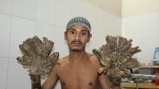 'Tree man' gets his hands back