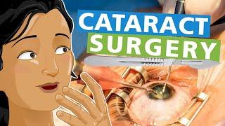 Cataracts