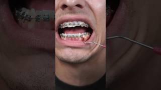 Removing buildup from braces 